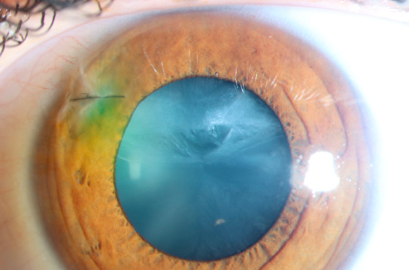 Capsular violation following a corneal laceration. 